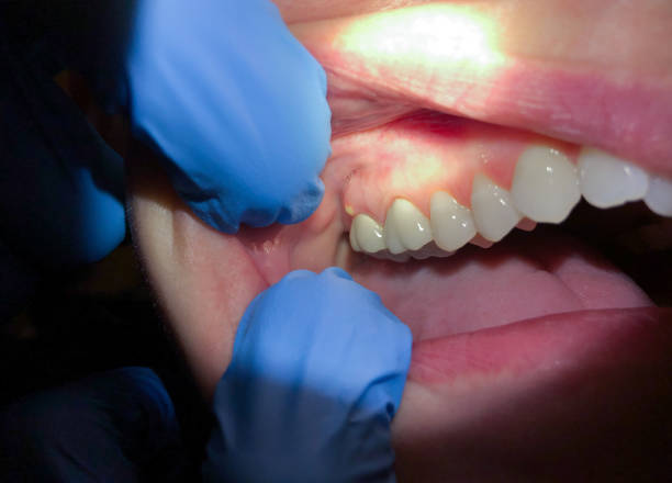 Best Emergency Root Canal Treatment in St Peter, MN